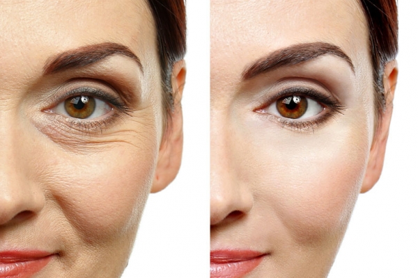 Kosmetisches Lifting