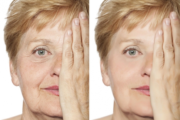 Kosmetisches Lifting